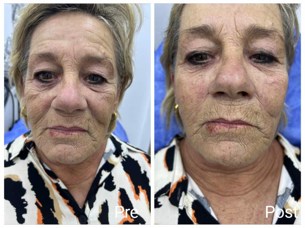 Facial filler injections in Hurghada