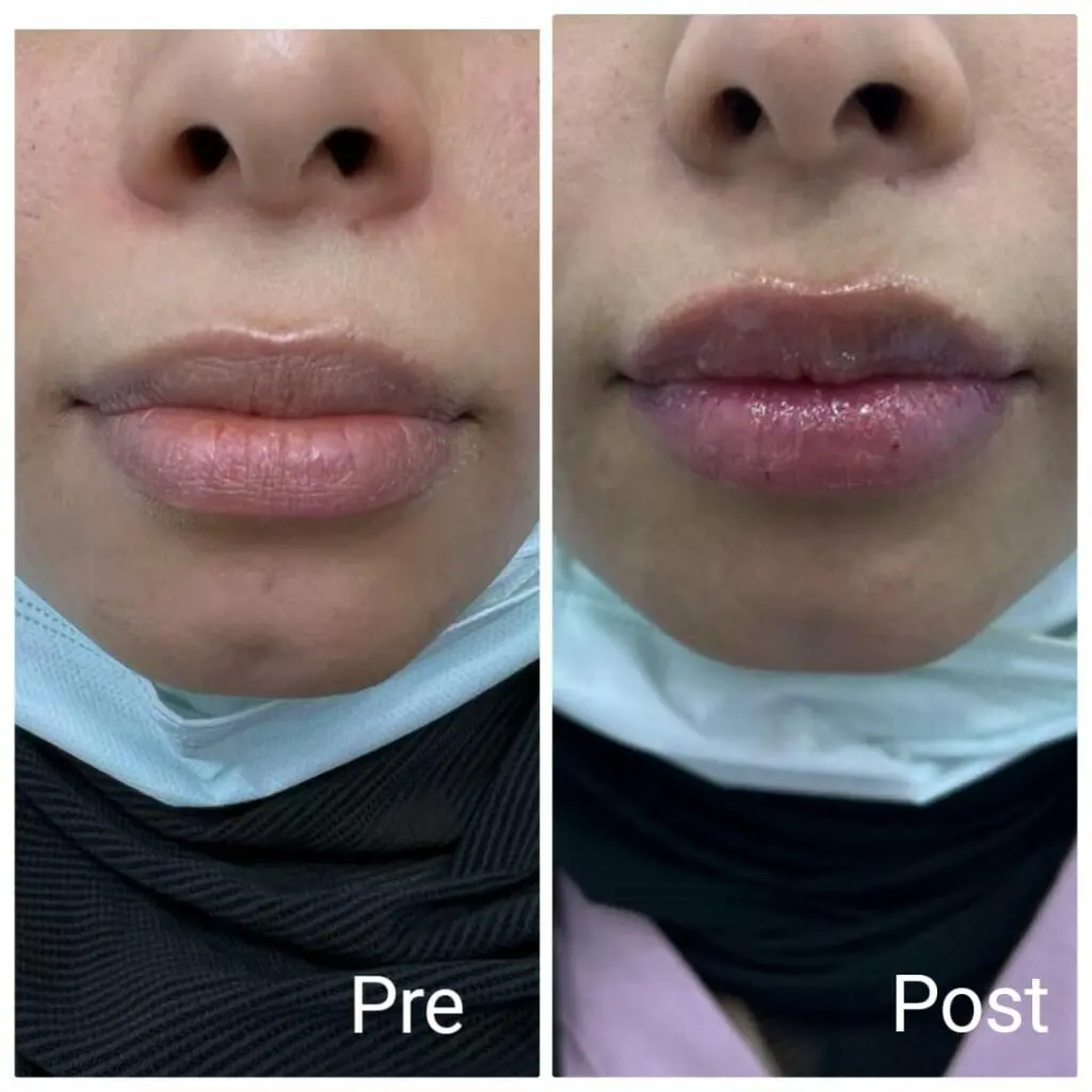 Lip filler injections