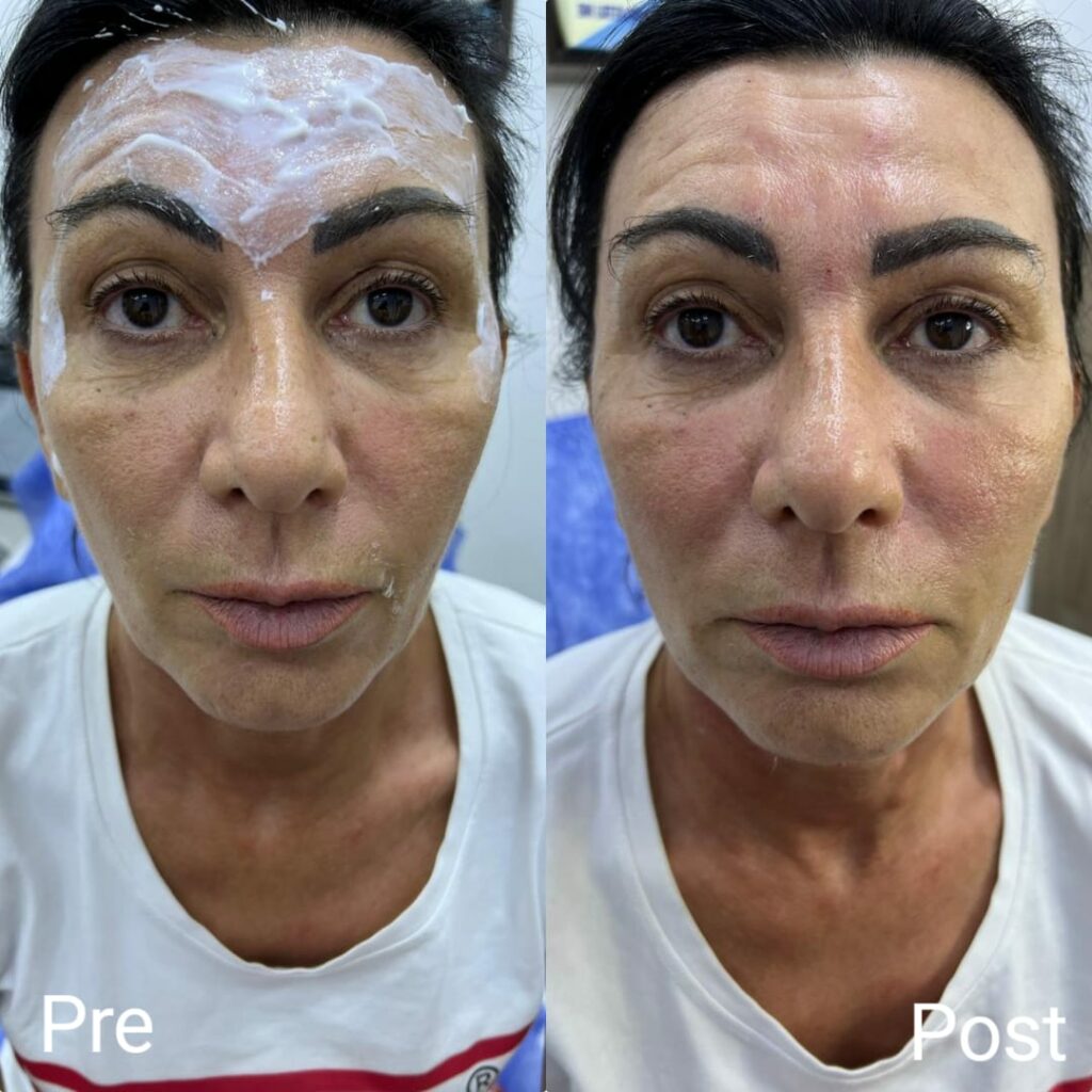Face filler before and after