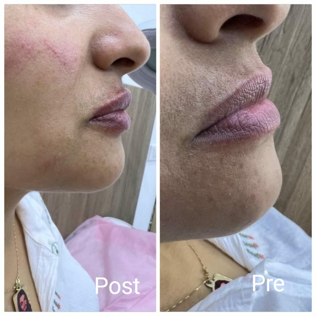 Lip contour filler before and after 