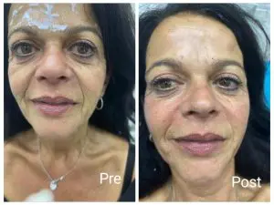 The result of the first session Sculptra 30% injection from the final result