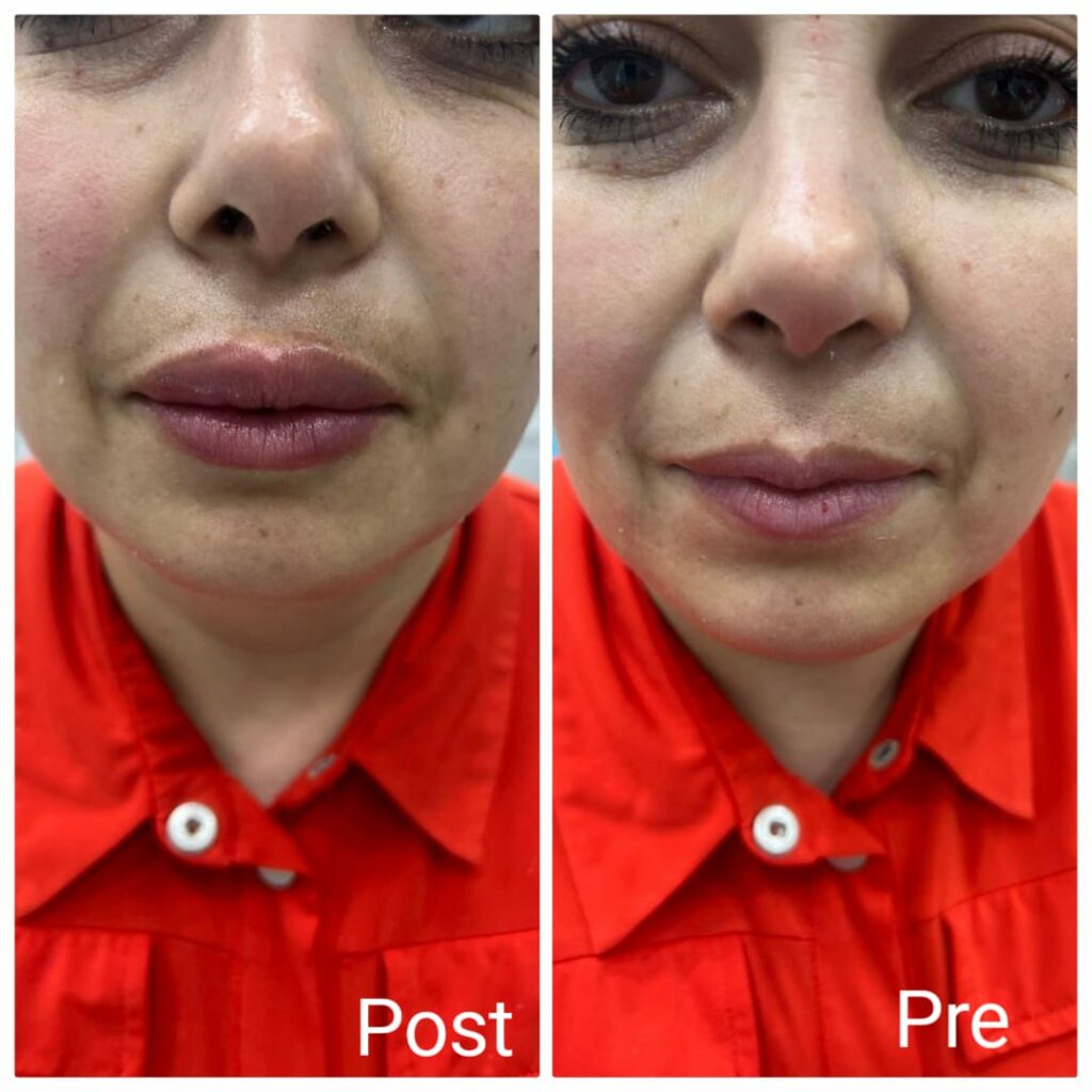 Lip augmentation with fillers