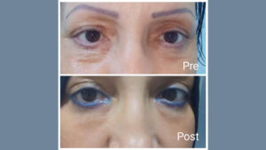 remove bags under eyes in Hurghada