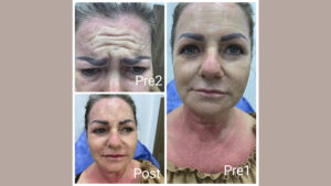 Botox and fillers in Hurghada