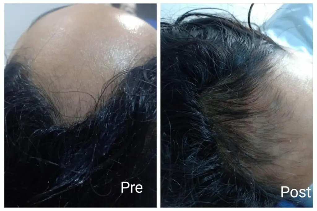 Alopecia treatment in Hurghada and the result after 3 sessions