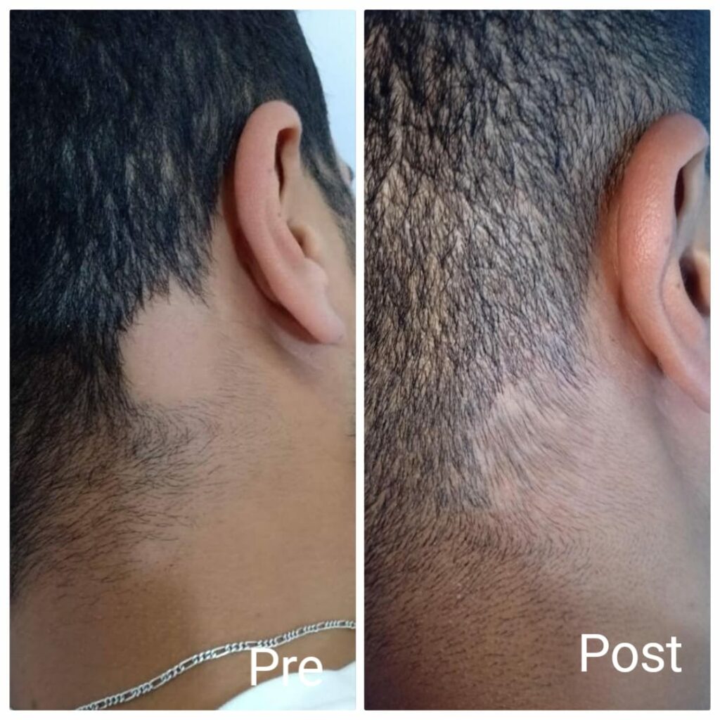Alopecia treatment before and after