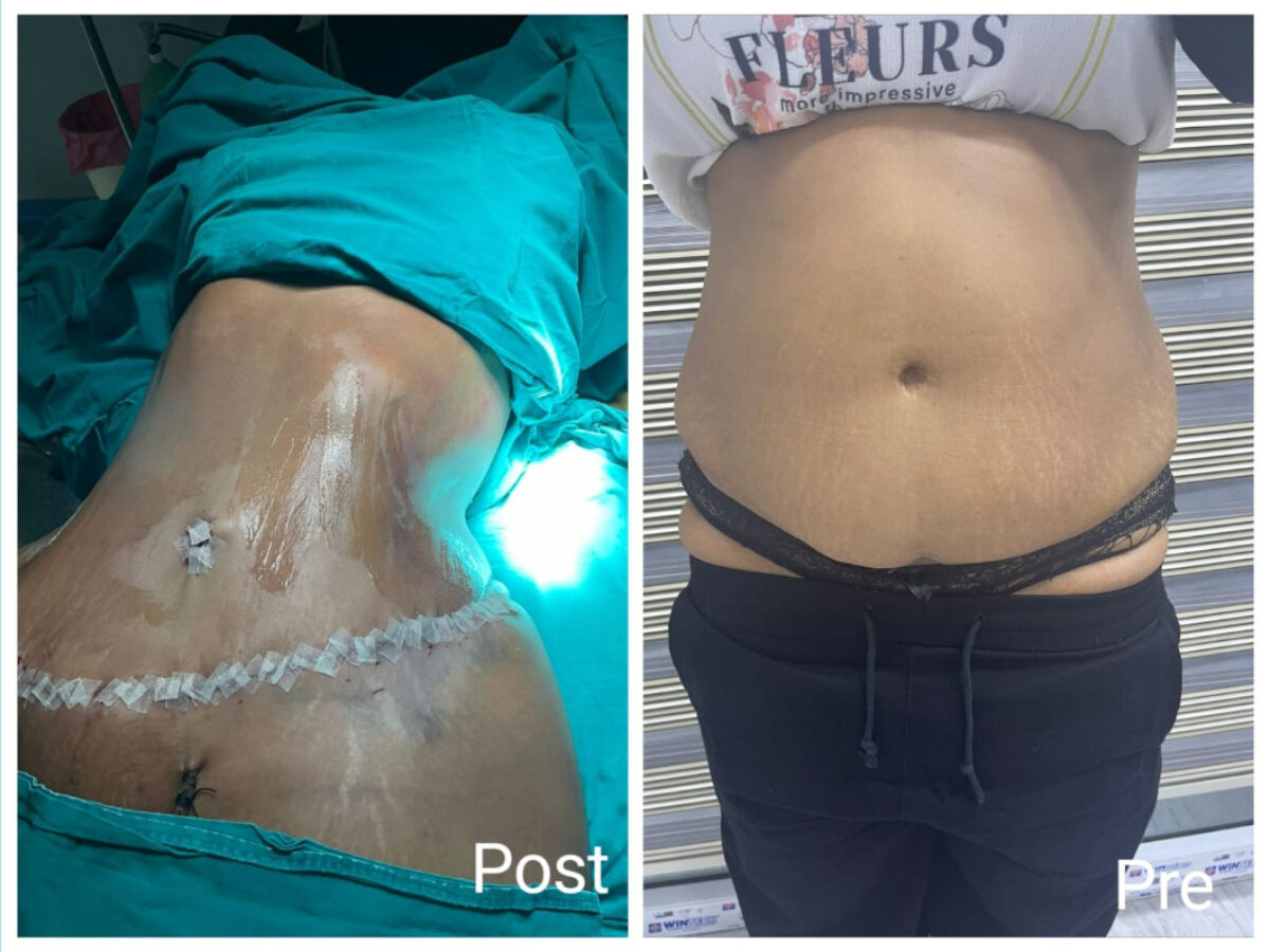 Tummy tuck in Hurghada, Book now