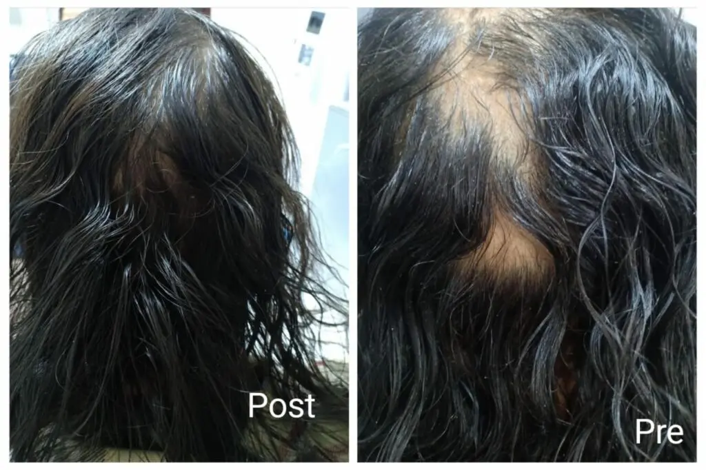 The final results after alopecia areata treatment at Nadara Clinic