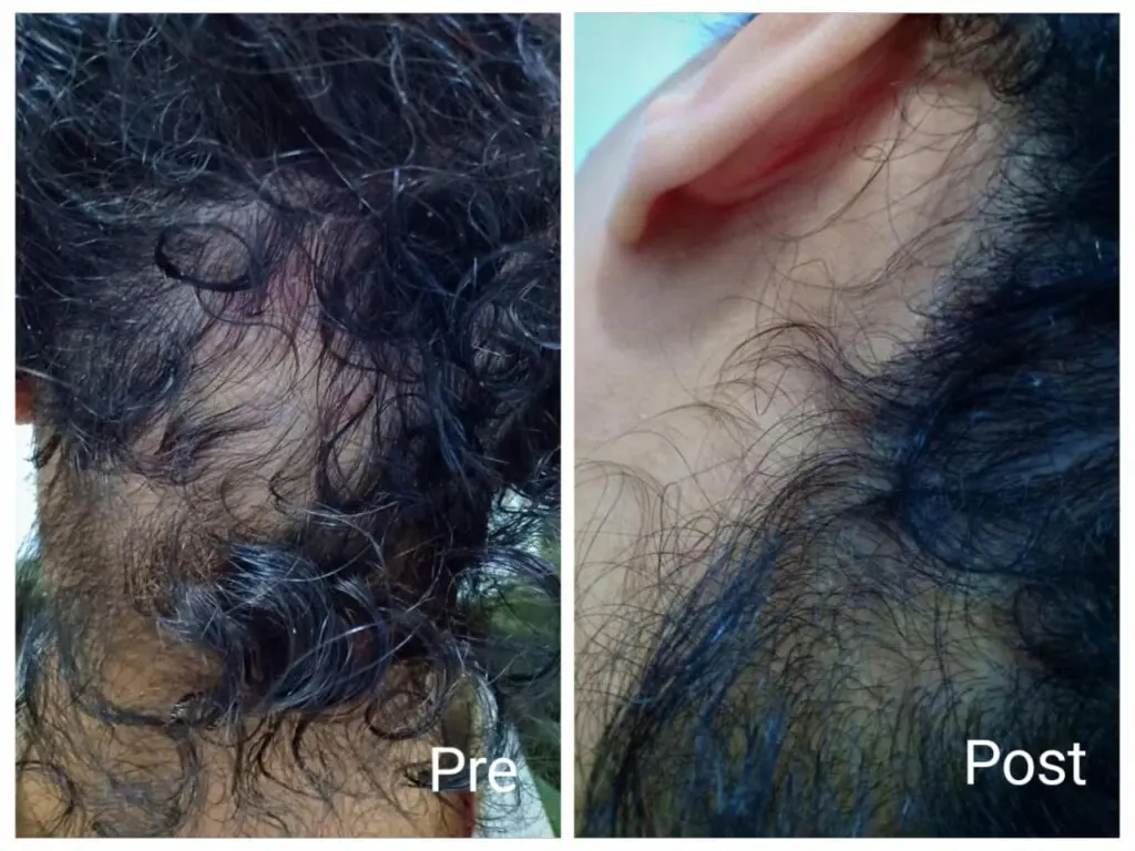 Alopecia treatment result after 4 sessions