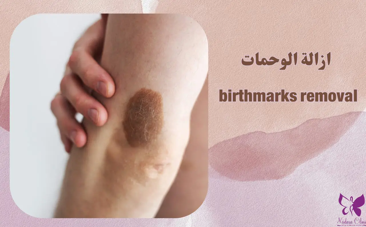 Birthmark removal in Hurghada