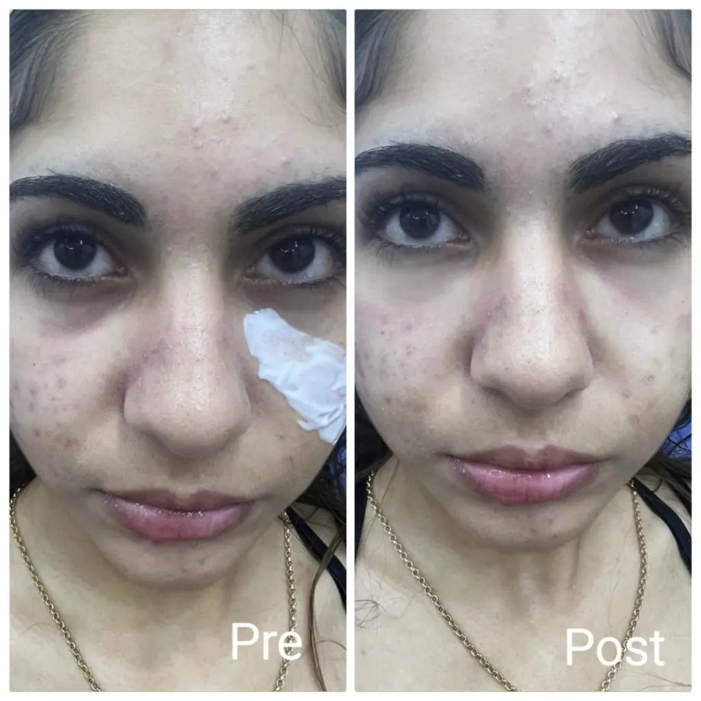 Improving the hollow area under the eyes in Hurghada