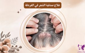 Hair psoriasis treatment in Hurghada