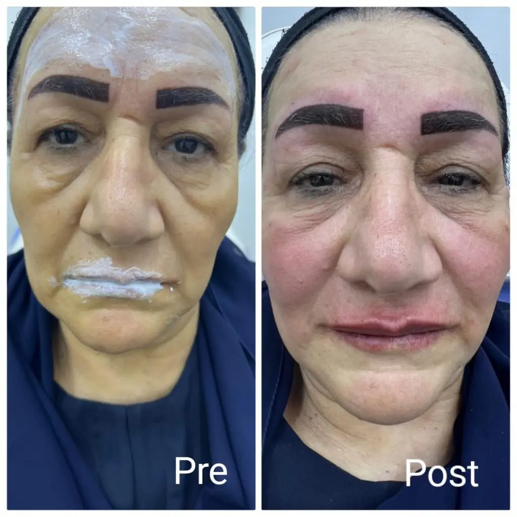 Cheek augmentation before and after