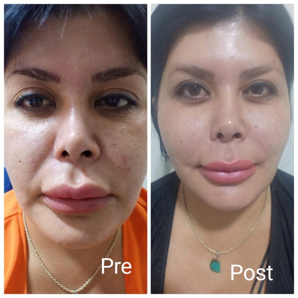 Cheek augmentation before and after