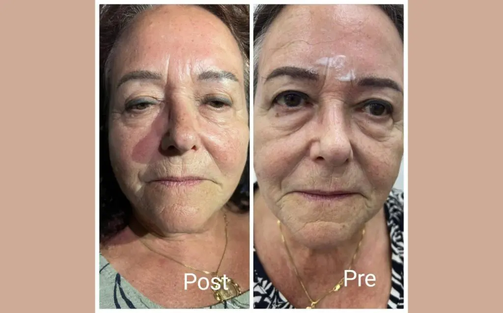 cheek augmentation in hurghada