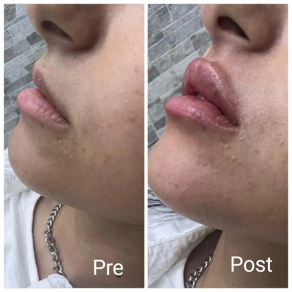 Best results with lip filler doctors in Hurghada
