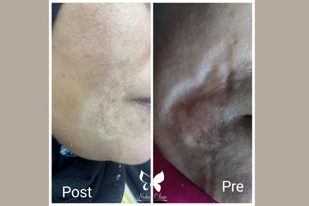 Subcision for acne scars in Hurghada