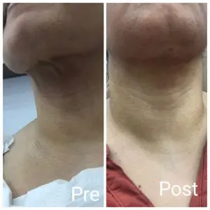 Neck lift and chin contouring in Hurghada