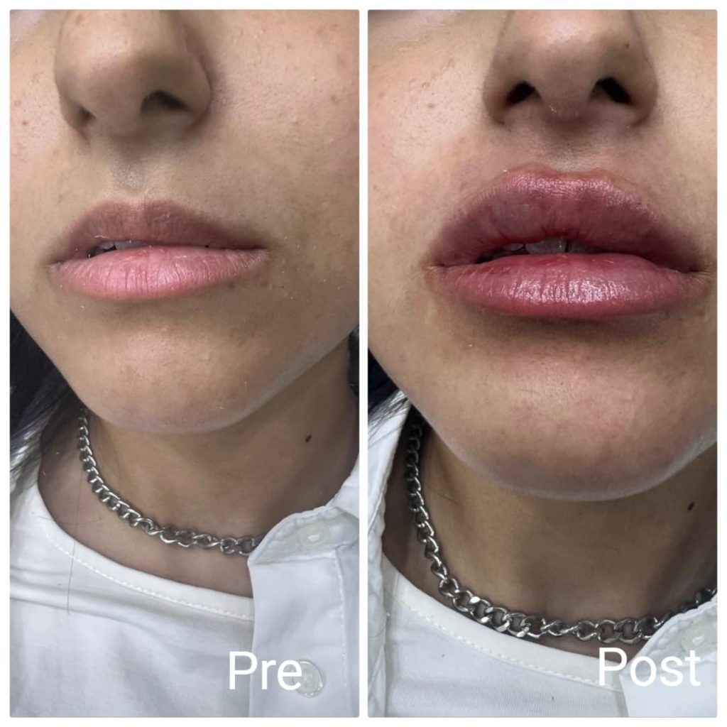 Define and enlarge lips with fillers