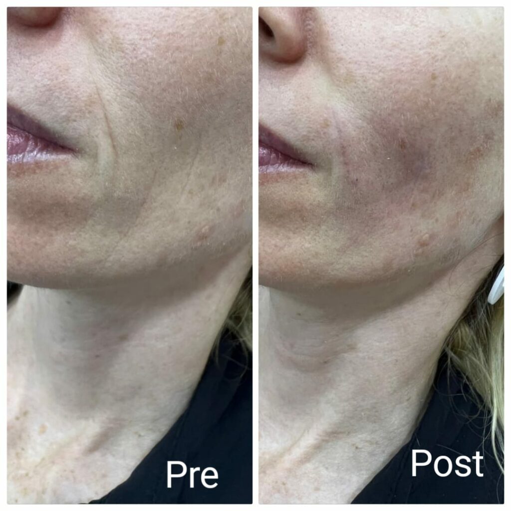 Filler injections for the face