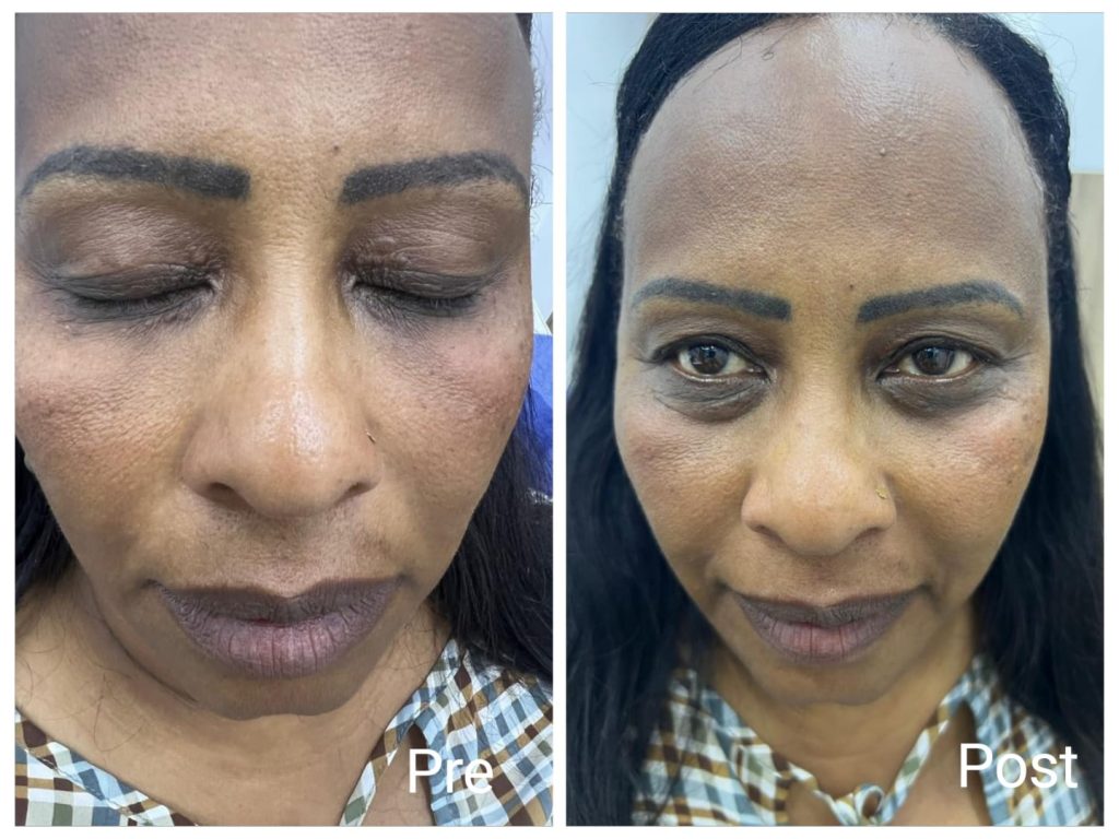 Hyaluronic acid filler injections for the face