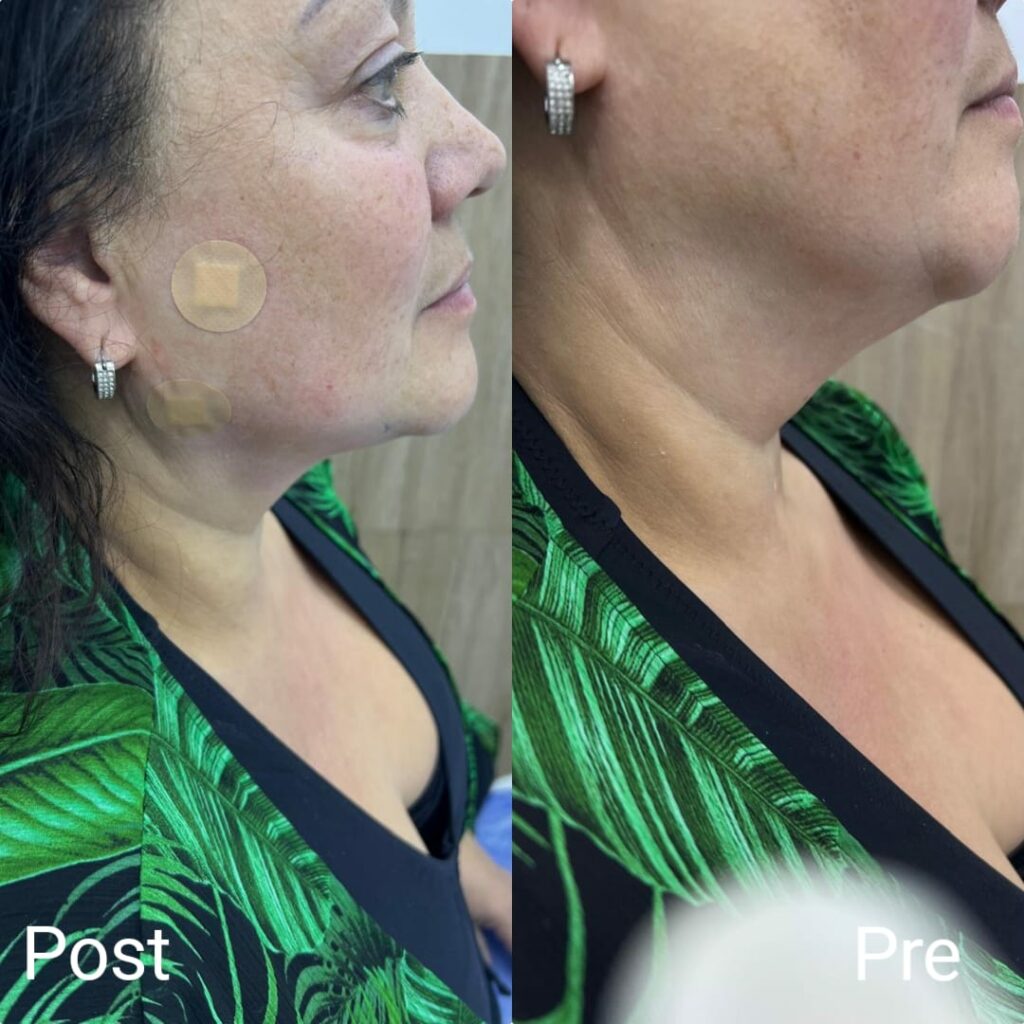 Neck lift before and after