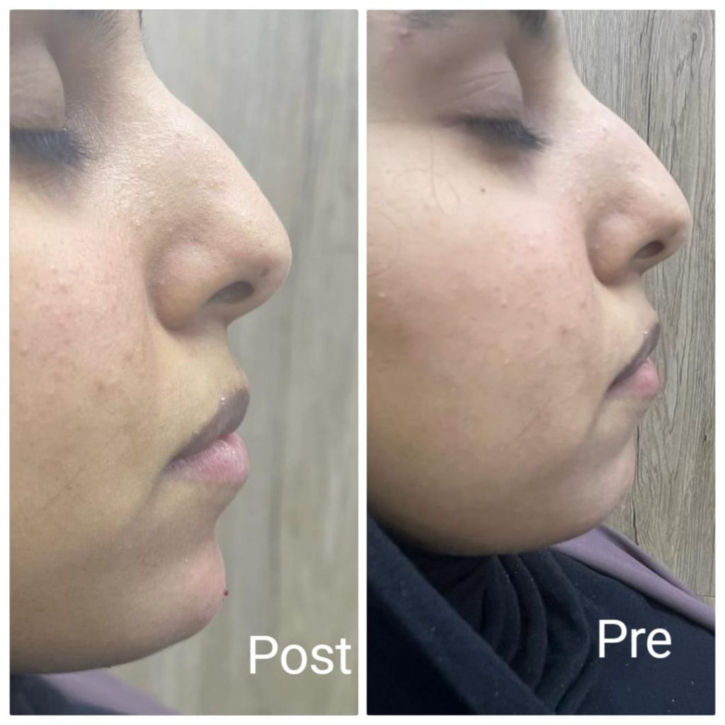 Filler to define and highlight the jaw and chin