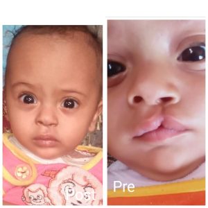 Results of cleft lip treatment before and after
