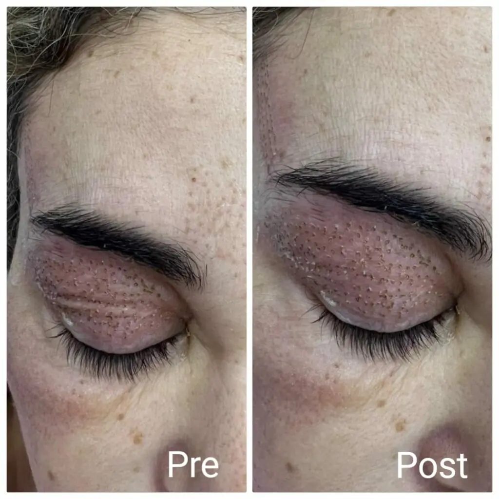 Instant results during an eyelid tightening session