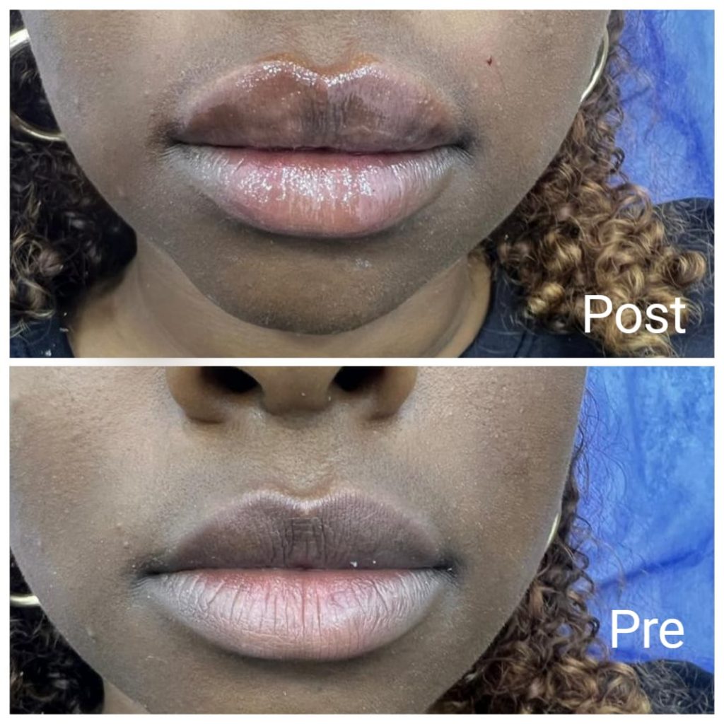 Lip augmentation with fillers before and after