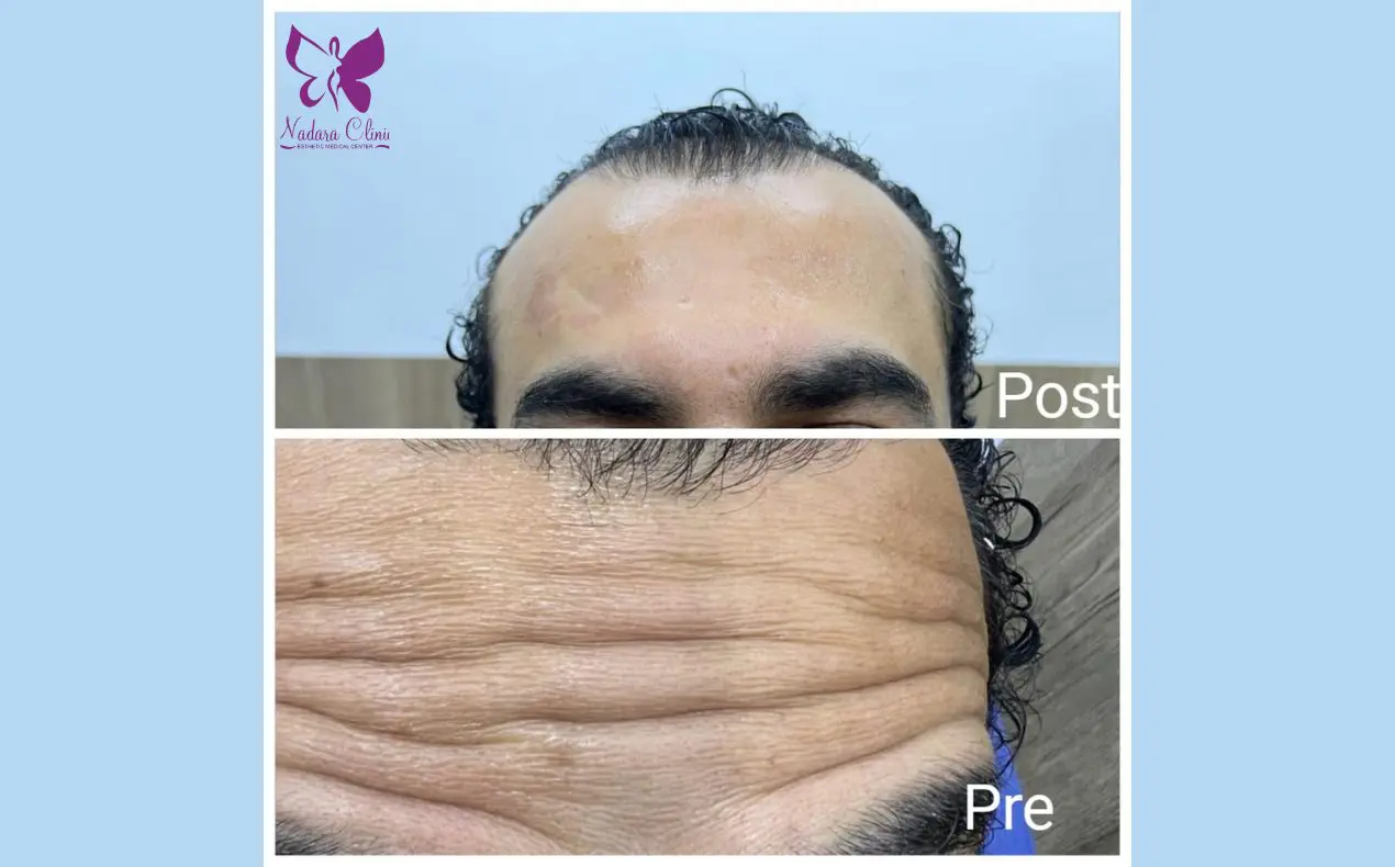 Botox injection doctors in Hurghada