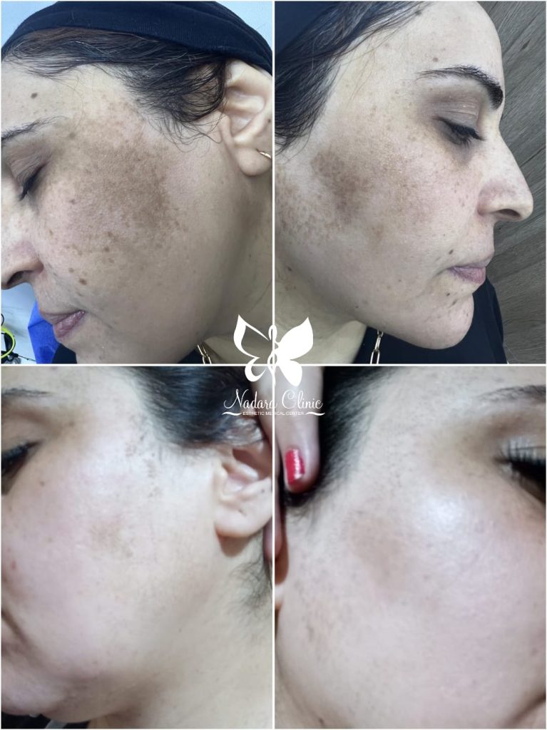 Best results with laser doctors for pigmentation in Hurghada