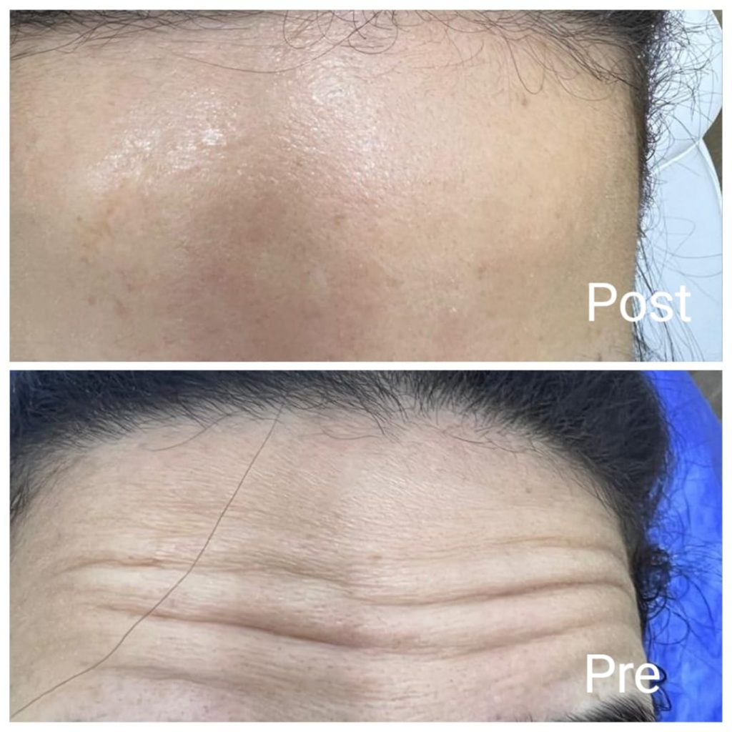 Removing forehead wrinkles with Botox