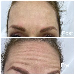 Botox before and after in Ras Ghareb