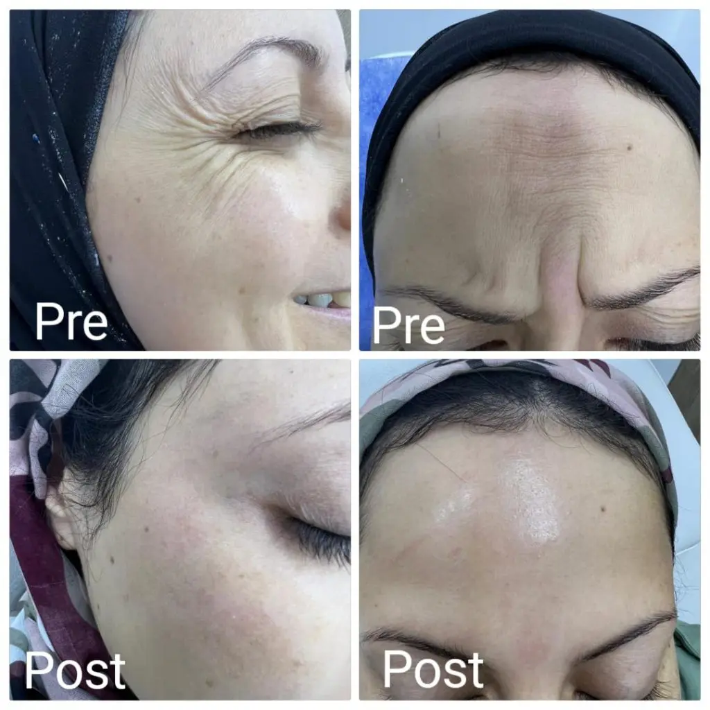 Treating wrinkles around the eyes and forehead with Botox