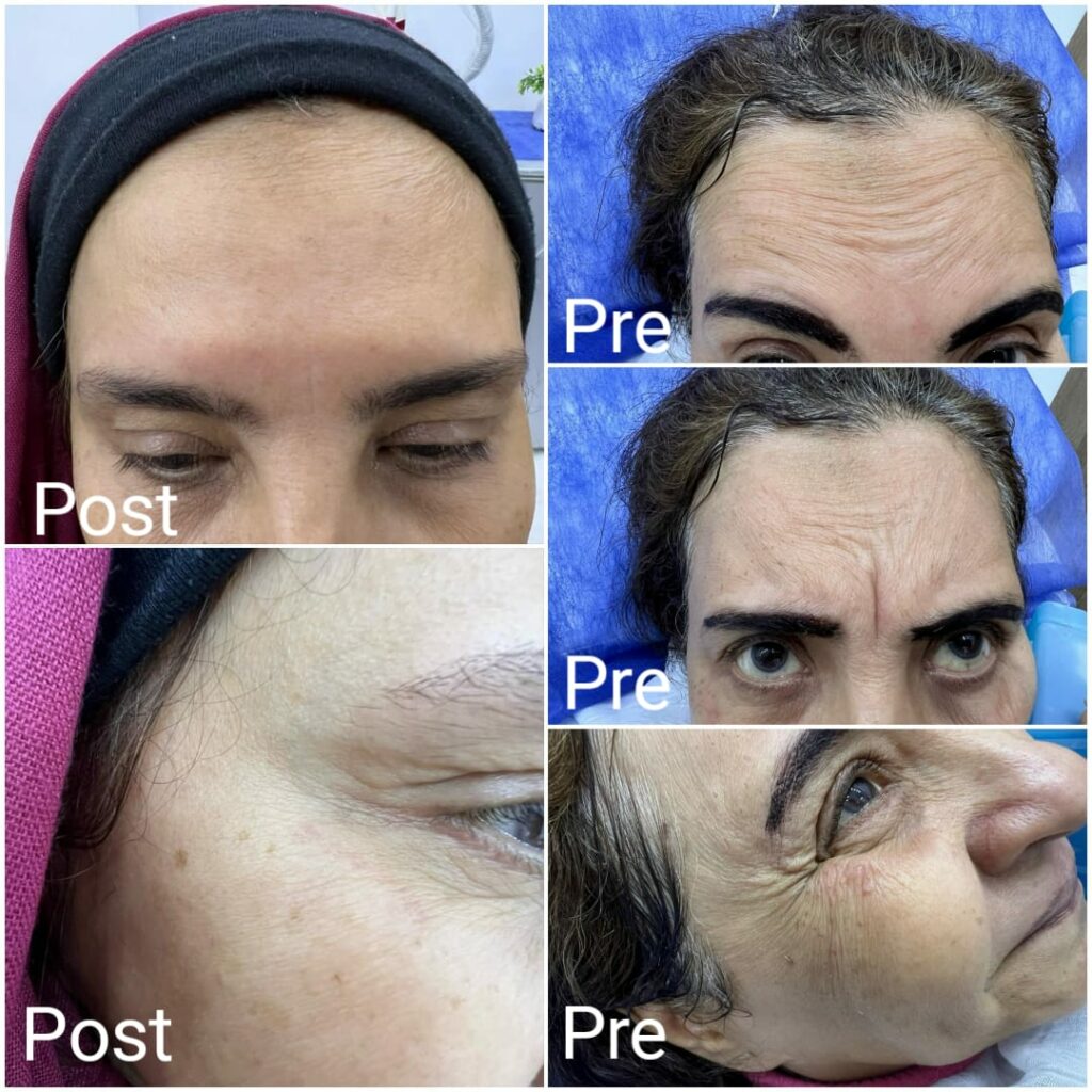 Botox injections into the forehead and around the eyes