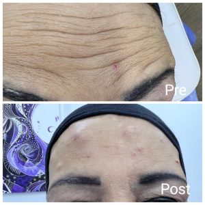 Botox injection in Ras Gharib
