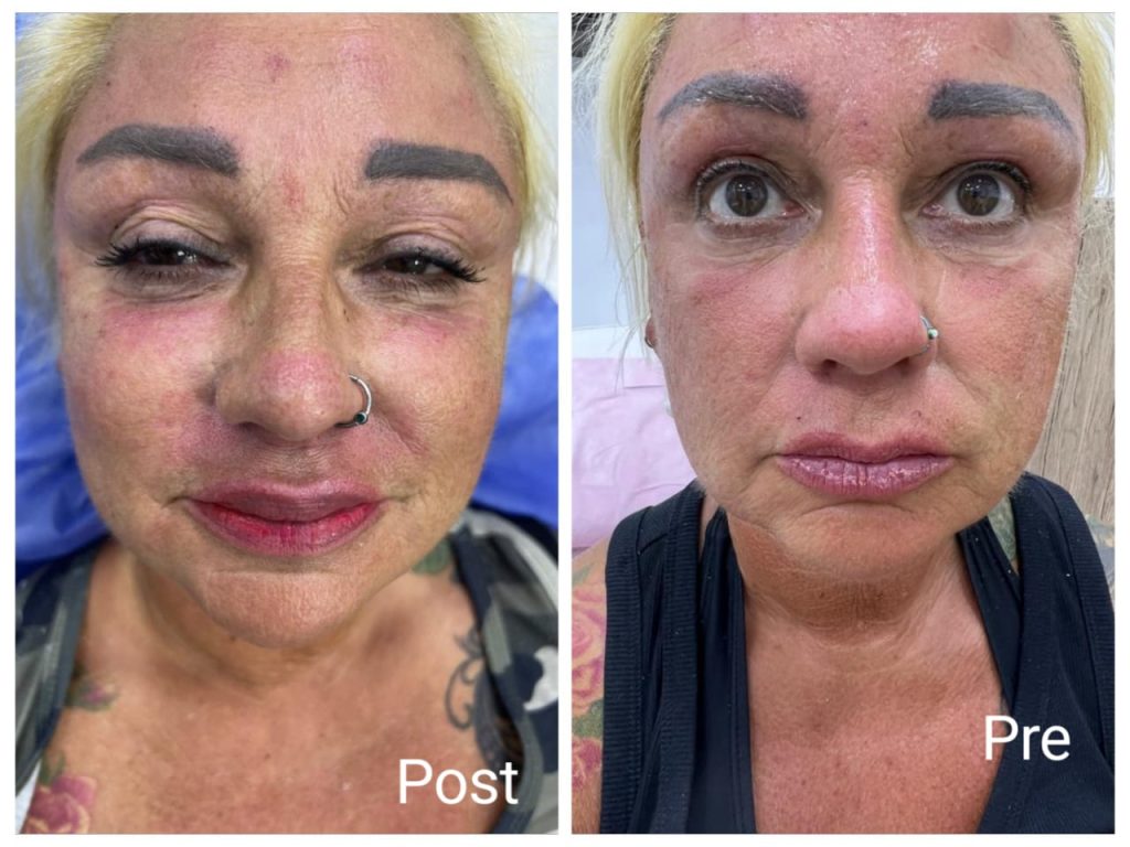 Hyaluronic injections before and after
