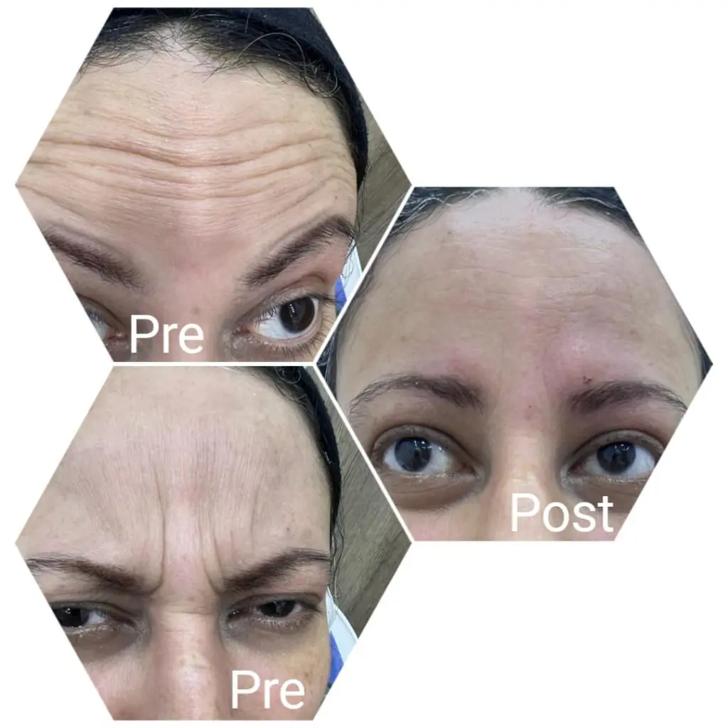 Injecting wrinkles on the forehead and between the eyebrows with Botox