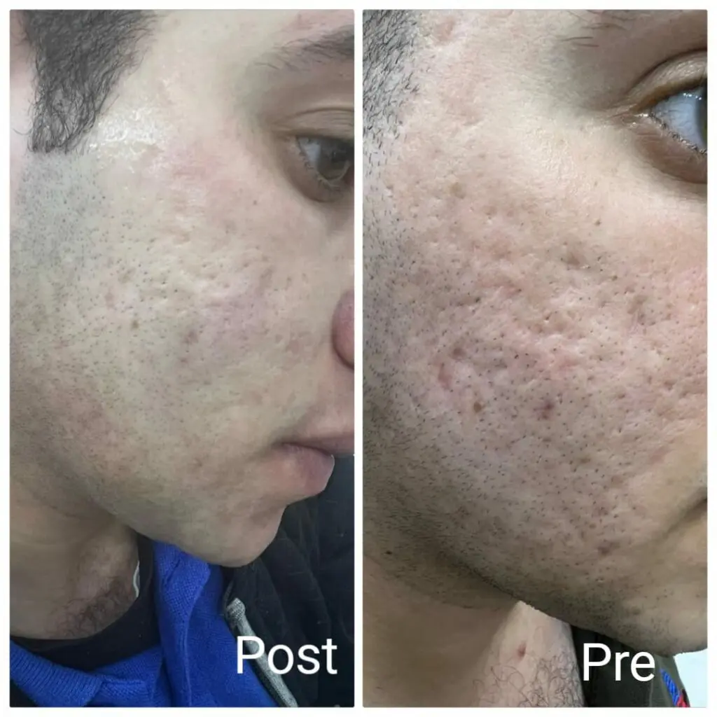 Treating large pores before and after one session