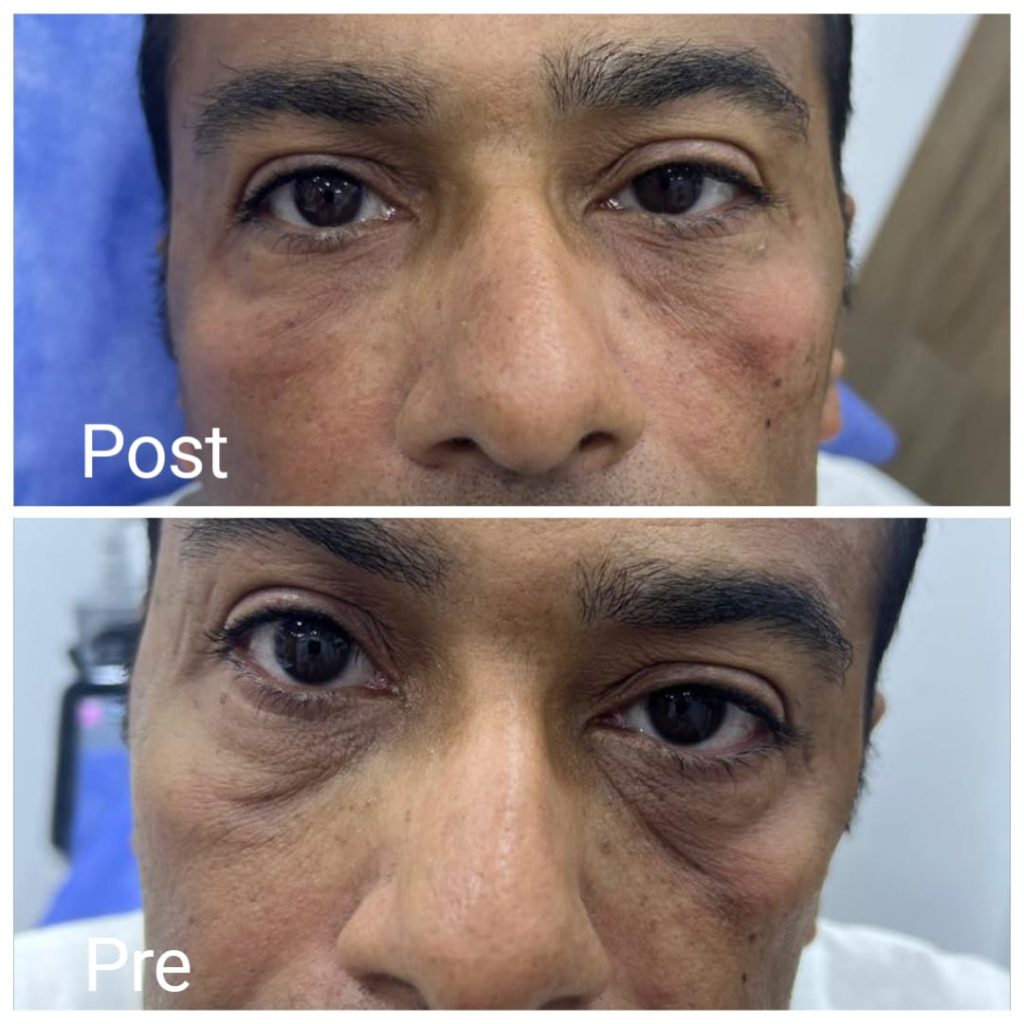 Improving the appearance of under the eyes with fillers