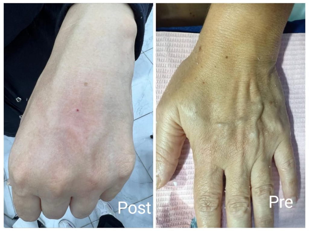 Treatment of hand wrinkles in Hurghada