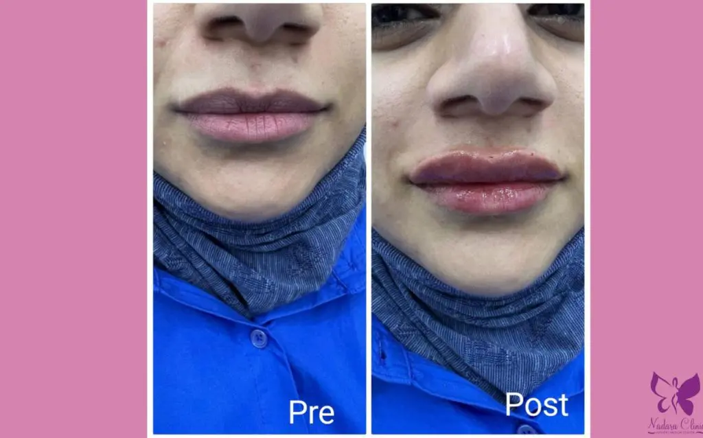 Lip filler doctors in Hurghada