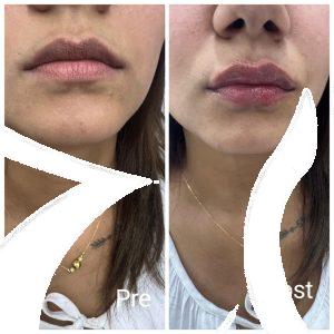 Lip filler with the best dermatologist and plastic surgeon in Ras Ghareb