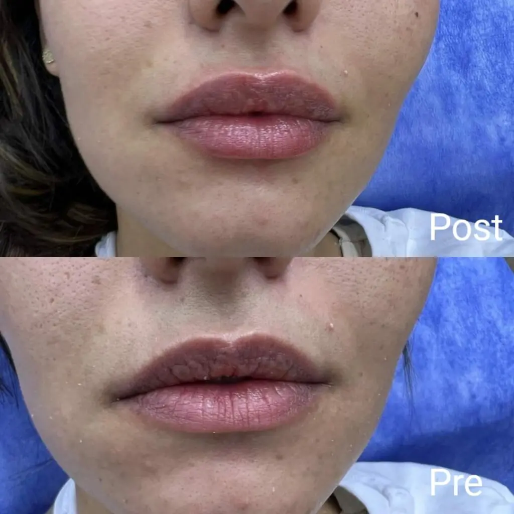 Lip filler before and after