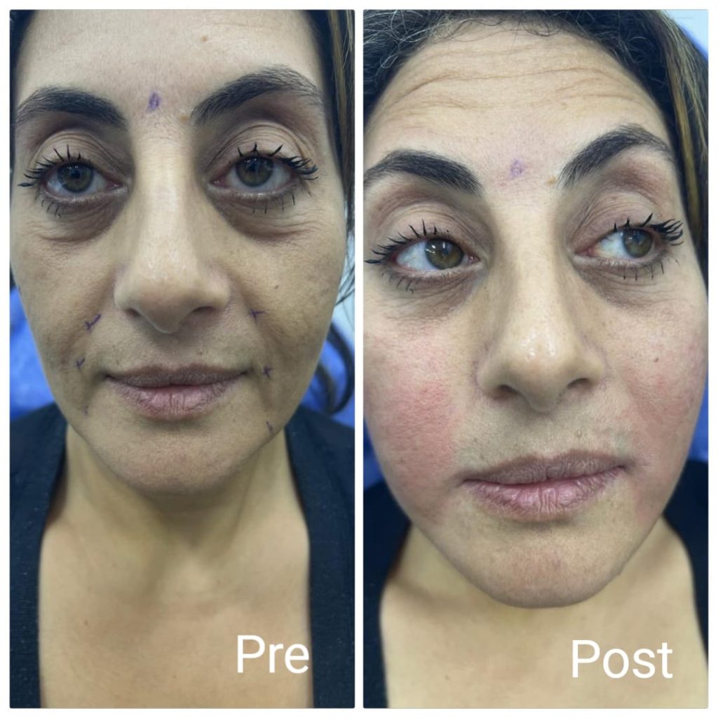 Results of plasma filler injections to the face