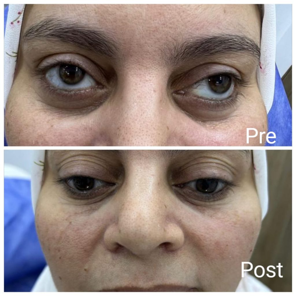 Under eye filler before and after