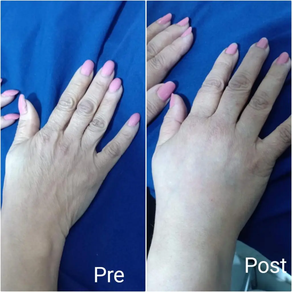 Better looking hands with hand wrinkle treatment doctors