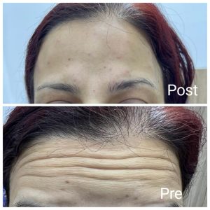 Results of Botox injections in Ras Gharib before and after