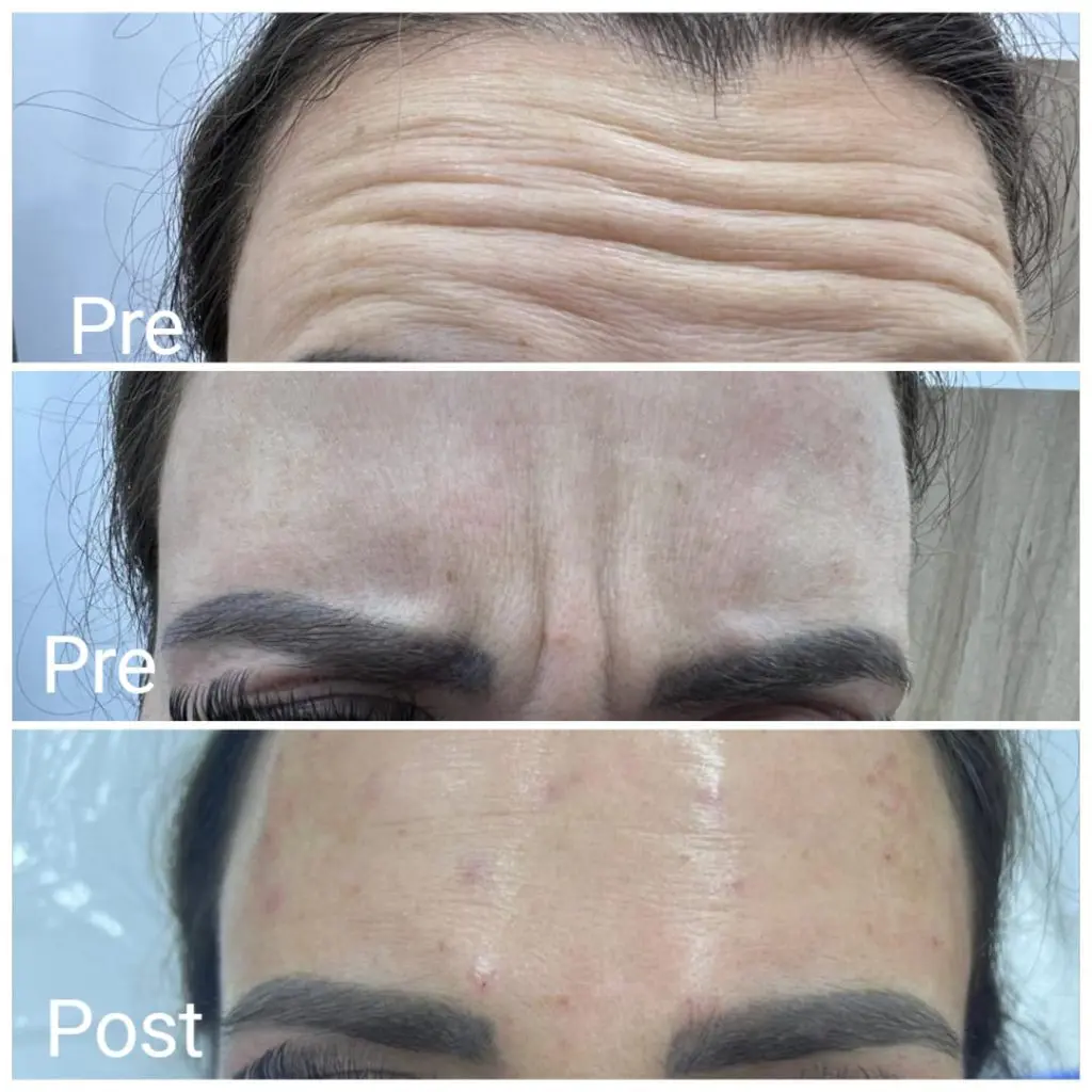 Botox injection results before and after